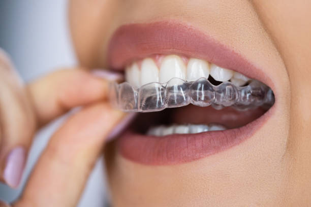 Navigating Your Invisalign Journey: Tips for a Seamless Experience